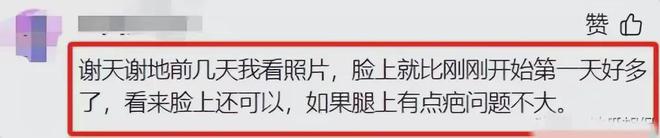 半岛·综合体育入口烧伤妈妈最新情况曝光！丈夫惊喜：脸部皮肤基本长好！(图6)